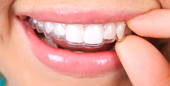 Invisalign Provider At Yonge-Eglinton in Toronto