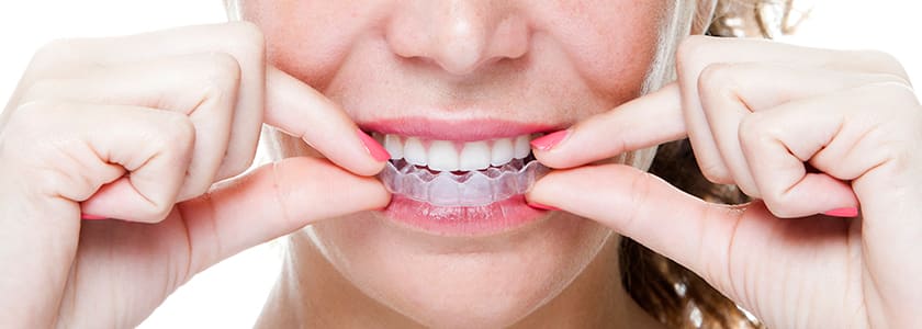 Invisalign in Yonge-Eglinton Toronto